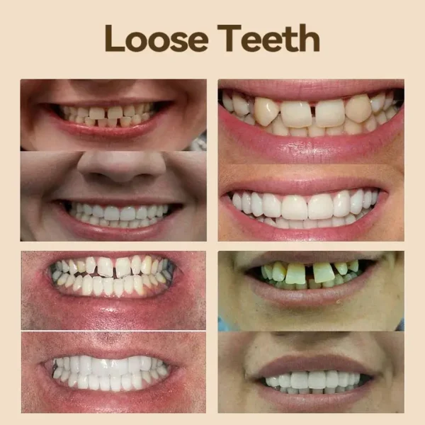 𝐇𝐢𝐝𝐨𝐧𝐞® 🎈🎈- 𝐏𝐫𝐞𝐦𝐢𝐮𝐦 𝐃𝐞𝐧𝐭𝐮𝐫𝐞- (👩‍🔬ADA 𝐶𝑜𝑚𝑝𝑙𝑖𝑎𝑛𝑡 𝐴𝑝𝑝𝑟𝑜𝑣𝑒𝑑 𝐵𝑦 𝑃𝑟𝑜𝑓𝑒𝑠𝑠𝑖𝑜𝑛𝑎𝑙 𝐷𝑒𝑛𝑡𝑖𝑠𝑡𝑠）