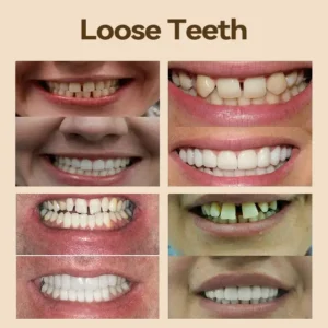 𝐇𝐢𝐝𝐨𝐧𝐞® 🐱‍🐉💦- 𝐏𝐫𝐞𝐦𝐢𝐮𝐦 𝐃𝐞𝐧𝐭𝐮𝐫𝐞- (✨Suitable for all mouth shapes, custom-made dentures for a perfect fit✨）