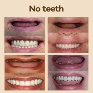 𝐇𝐢𝐝𝐨𝐧𝐞® 🐱‍🐉💦- 𝐏𝐫𝐞𝐦𝐢𝐮𝐦 𝐃𝐞𝐧𝐭𝐮𝐫𝐞- (✨Suitable for all mouth shapes, custom-made dentures for a perfect fit✨）