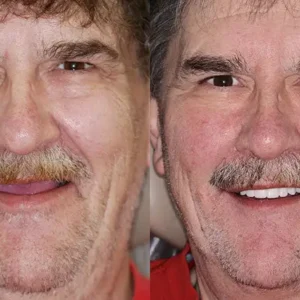𝐁𝐢𝐤𝐞𝐧𝐝𝐚® --🦷Advanced Customized Full Denture Set🦷🇺🇸 (⏰Limited time discount last 30 minutes⏰)