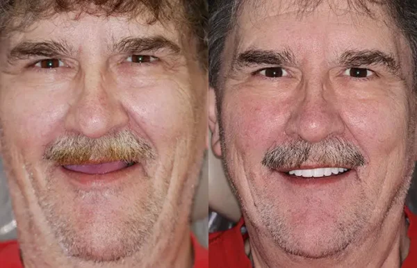 𝐁𝐢𝐤𝐞𝐧𝐝𝐚® --🦷Advanced Customized Full Denture Set🦷🇺🇸 (⏰Limited time discount last 30 minutes⏰)