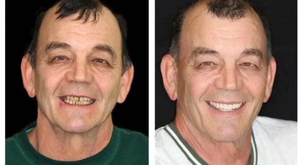𝐁𝐢𝐤𝐞𝐧𝐝𝐚® --🦷Advanced Customized Full Denture Set🦷🇺🇸 (⏰Limited time discount last 30 minutes⏰)