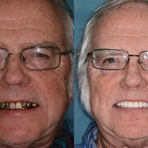 𝐁𝐢𝐤𝐞𝐧𝐝𝐚® --🦷Advanced Customized Full Denture Set🦷🇺🇸 (⏰Limited time discount last 30 minutes⏰)