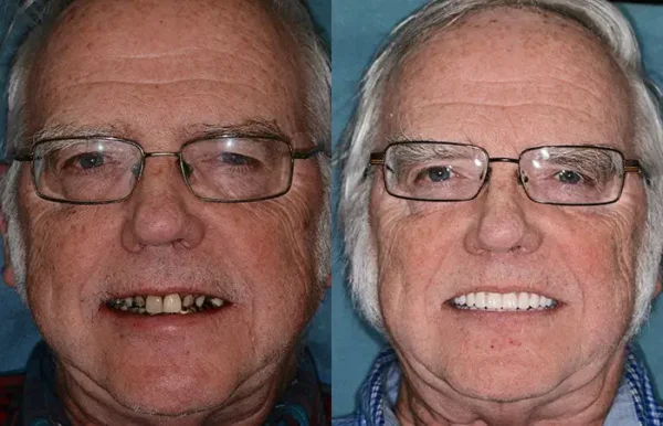 𝐁𝐢𝐤𝐞𝐧𝐝𝐚® --🦷Advanced Customized Full Denture Set🦷🇺🇸 (⏰Limited time discount last 30 minutes⏰)