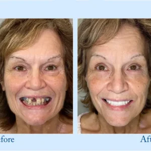 𝐇𝐢𝐝𝐨𝐧𝐞® 🦷Advanced Customized Full Denture Set🦷 (⏰Limited time discount last 30 minutes⏰)🍁🍁