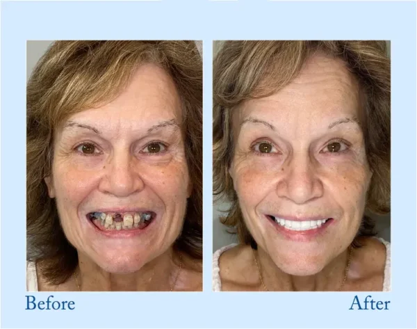 𝐇𝐢𝐝𝐨𝐧𝐞® 🦷Advanced Customized Full Denture Set🦷 (⏰Limited time discount last 30 minutes⏰)🍁🍁