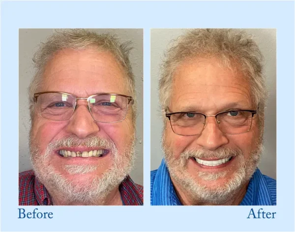 𝐇𝐢𝐝𝐨𝐧𝐞® 🦷Advanced Customized Full Denture Set🦷 (⏰Limited time discount last 30 minutes⏰)🍁🍁
