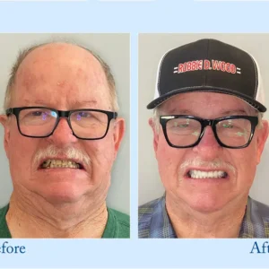 𝐇𝐢𝐝𝐨𝐧𝐞® 🦷Advanced Customized Full Denture Set🦷 (⏰Limited time discount last 30 minutes⏰)🍁🍁