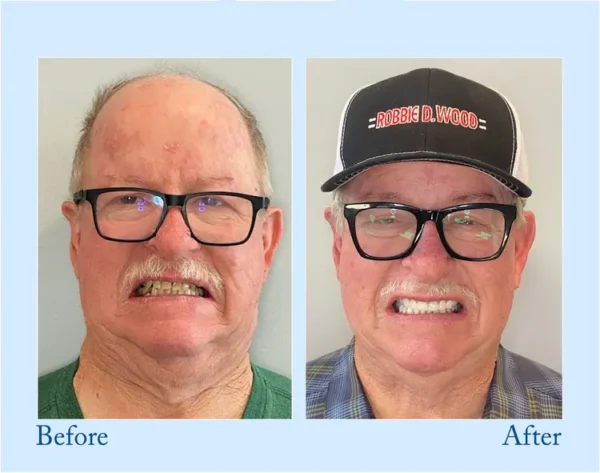 𝐇𝐢𝐝𝐨𝐧𝐞® 🦷Advanced Customized Full Denture Set🦷 (⏰Limited time discount last 30 minutes⏰)🍁🍁