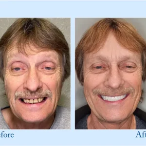 𝐇𝐢𝐝𝐨𝐧𝐞® 🦷Advanced Customized Full Denture Set🦷 (⏰Limited time discount last 30 minutes⏰)🍁🍁