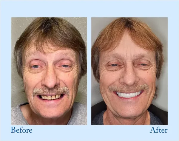 𝐇𝐢𝐝𝐨𝐧𝐞® 🦷Advanced Customized Full Denture Set🦷 (⏰Limited time discount last 30 minutes⏰)🍁🍁