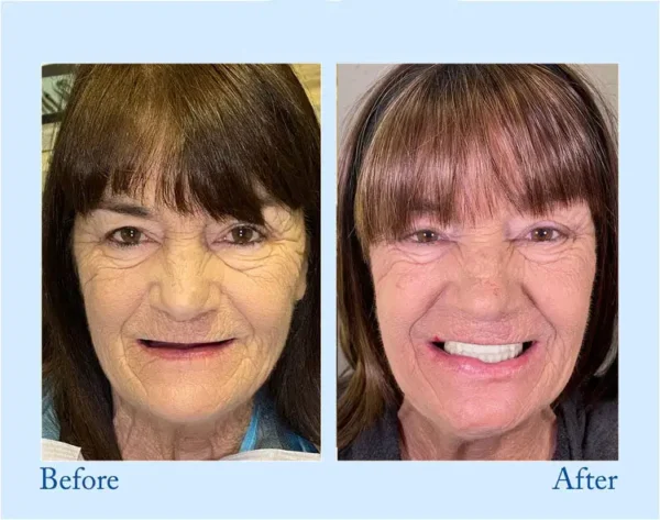 𝐇𝐢𝐝𝐨𝐧𝐞® 🦷Advanced Customized Full Denture Set🦷 (⏰Limited time discount last 30 minutes⏰)🍁🍁