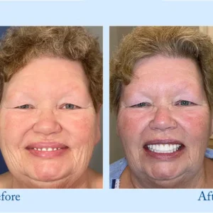 𝐇𝐢𝐝𝐨𝐧𝐞® 🦷Advanced Customized Full Denture Set🦷 (⏰Limited time discount last 30 minutes⏰)🍁🍁