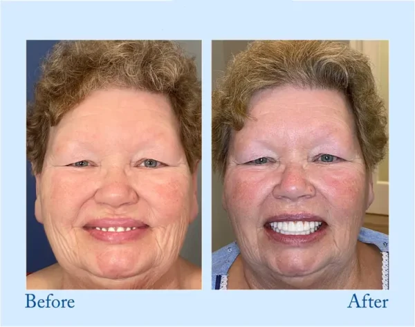 𝐇𝐢𝐝𝐨𝐧𝐞® 🦷Advanced Customized Full Denture Set🦷 (⏰Limited time discount last 30 minutes⏰)🍁🍁