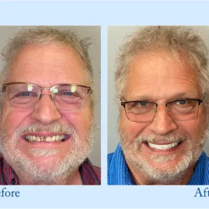 𝐇𝐢𝐝𝐨𝐧𝐞®💛 --🦷Custom Full Denture Set🦷 (⏰Limited Time Discount, Last 30 Minutes⏰)