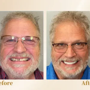 Hidone® --🦷Advanced Customized Full Denture Set🦷 (⏰Limited time discount last 30 minutes⏰)💎💎