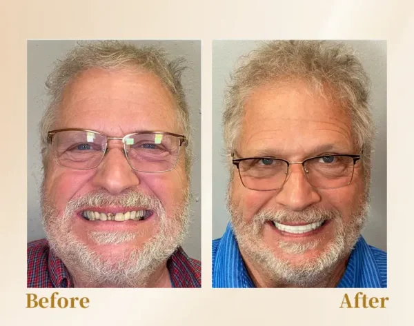 Hidone® --🦷Advanced Customized Full Denture Set🦷 (⏰Limited time discount last 30 minutes⏰)💎💎