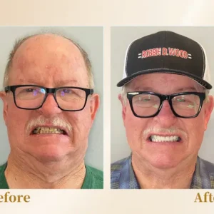 Hidone® --🦷Advanced Customized Full Denture Set🦷 (⏰Limited time discount last 30 minutes⏰)💎💎