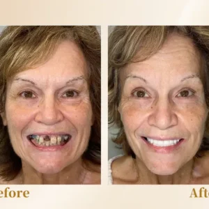 Hidone® --🦷Advanced Customized Full Denture Set🦷 (⏰Limited time discount last 30 minutes⏰)💎💎