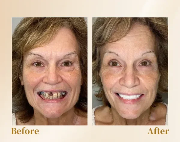 Hidone® --🦷Advanced Customized Full Denture Set🦷 (⏰Limited time discount last 30 minutes⏰)💎💎