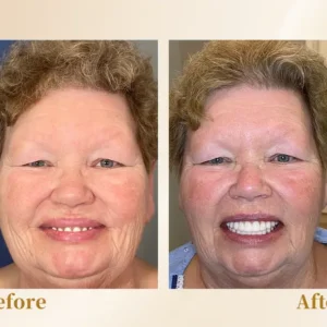 Hidone® --🦷Advanced Customized Full Denture Set🦷 (⏰Limited time discount last 30 minutes⏰)💎💎