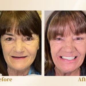 Hidone® --🦷Advanced Customized Full Denture Set🦷 (⏰Limited time discount last 30 minutes⏰)💎💎
