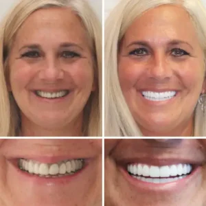 Hidone®Full Denture Set🦷Advanced Self-Adjusting Dental Materials💃💃 (⏰Limited time discount last 30 minutes⏰)