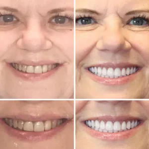 Hidone®Full Denture Set🦷Advanced Self-Adjusting Dental Materials💃💃 (⏰Limited time discount last 30 minutes⏰)