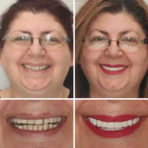 Hidone®Full Denture Set🦷Advanced Self-Adjusting Dental Materials💃💃 (⏰Limited time discount last 30 minutes⏰)