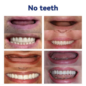 NESLEMY-🦷Advanced Customized Full Denture Set🦷 (⏰Limited time discount last 30 minutes⏰)