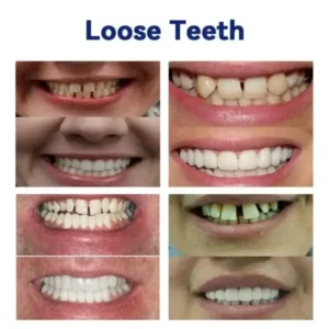Vaxflite™ Ease Dentures