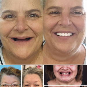 𝐇𝐢𝐝𝐨𝐧𝐞® 🦷Advanced Customized Full Denture Set🦷 (🔥10,000+ Sold In Last 30 Day)