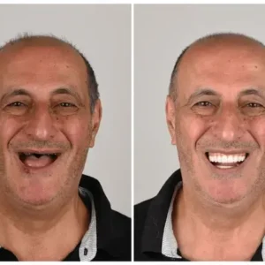 🦷 NESLEMY™ Custom-Fit Functional Dentures 😁 Smile with Confidence