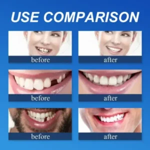 (Affordable Beauty🧏‍♀️🧏‍♂️)–NESLEMY™ –Advanced Customized Full Denture Set🦷