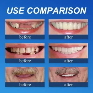 (Affordable Beauty🧏‍♀️🧏‍♂️)–NESLEMY™ –Advanced Customized Full Denture Set🦷