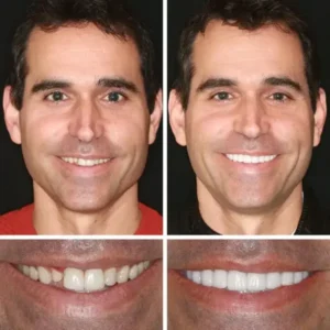 (Affordable Beauty🧏‍♀️🧏‍♂️)–NESLEMY™ –Advanced Customized Full Denture Set🦷