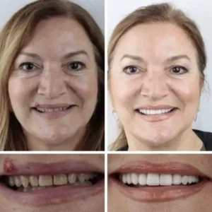(Affordable Beauty🧏‍♀️🧏‍♂️)–NESLEMY™ –Advanced Customized Full Denture Set🦷