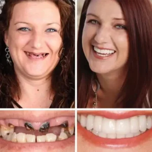 (Affordable Beauty🧏‍♀️🧏‍♂️)–NESLEMY™ –Advanced Customized Full Denture Set🦷