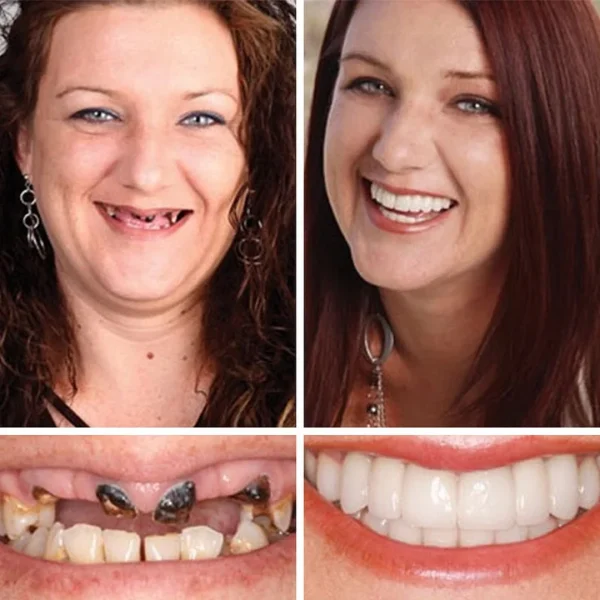 (Affordable Beauty🧏‍♀️🧏‍♂️)--Laozik™ --Advanced Customized Full Denture Set🦷