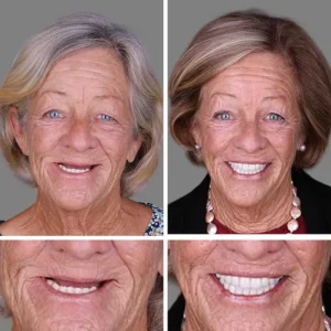 (Affordable Beauty🧏‍♀️🧏‍♂️)--Laozik™ --Advanced Customized Full Denture Set🦷