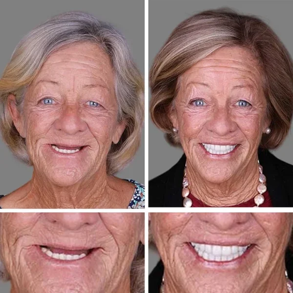 (Affordable Beauty🧏‍♀️🧏‍♂️)--Laozik™ --Advanced Customized Full Denture Set🦷