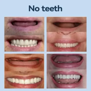 Bikenda® 👧🏻🔆- 𝐏𝐫𝐞𝐦𝐢𝐮𝐦 𝐃𝐞𝐧𝐭𝐮𝐫𝐞- (✨Suitable for all mouth shapes, custom-made dentures for a perfect fit✨）