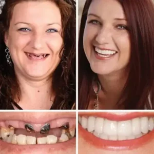 Clinclii™ –Advanced Customized Full Denture Set🦷