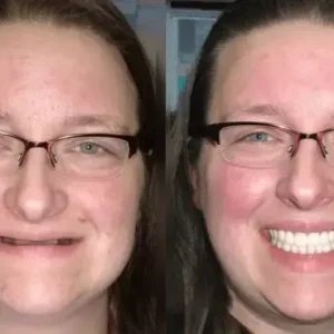 {Developed by Harvard University}🦷Advanced Customized Full Denture Set🦷