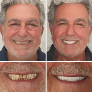 {Developed by Harvard University}🦷Advanced Customized Full Denture Set🦷
