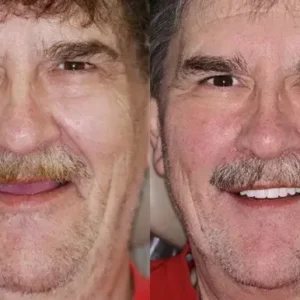 NESLEMY™ –🦷Advanced Customized Full Denture Set🦷