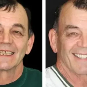NESLEMY™ –🦷Advanced Customized Full Denture Set🦷