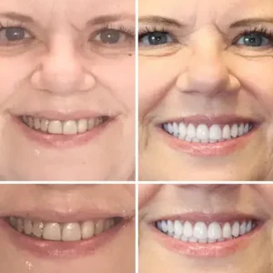 NESLEMY™ –🦷Advanced Customized Full Denture Set🦷
