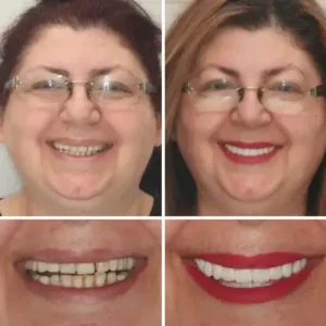 NESLEMY™ –🦷Advanced Customized Full Denture Set🦷