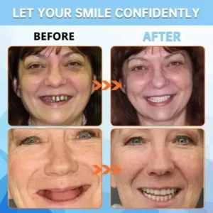 NESLEMY™-🦷Advanced Customized Full Denture Set🦷——Self-adsorbed in the mouth, comfortable to wear, worry-free chewing——your exclusive denture solution (⏰Limited time discount last 30 minutes⏰)